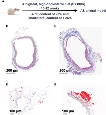 Metabolomics unveils the exacerbating role of arachidonic acid metabolism in atherosclerosis